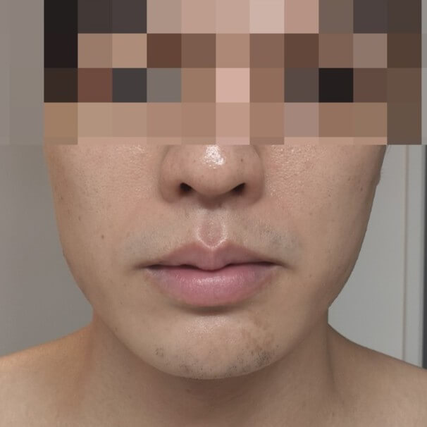 YAGレーザー照射　1週間後